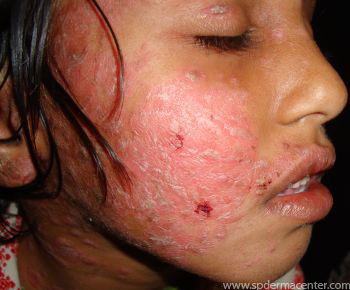 Psoriasis-Treated